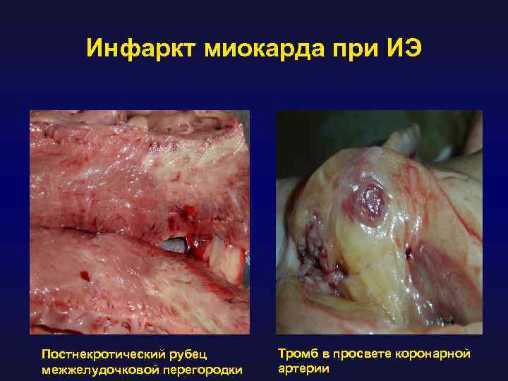 Инфаркт миокарда при ИЭ Постнекротический рубец межжелудочковой перегородки Тромб в просвете коронарной артерии 
