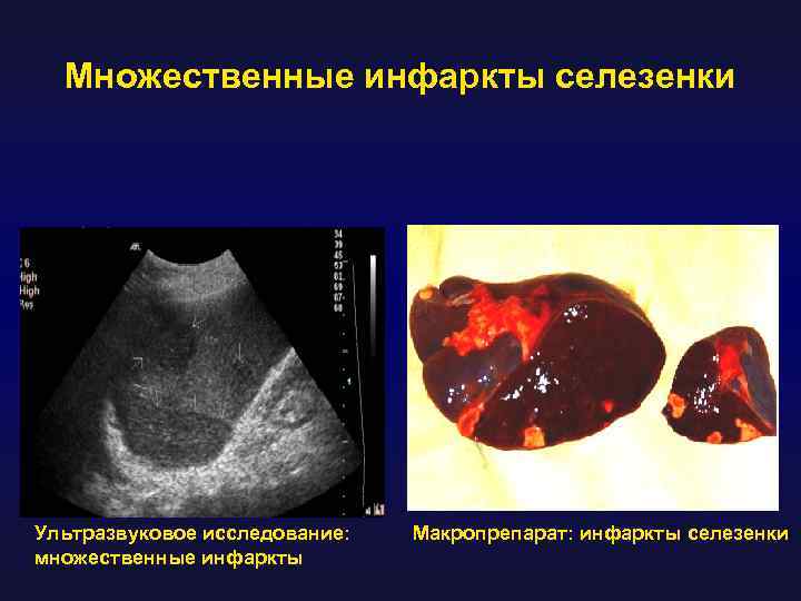Множественные инфаркты селезенки Ультразвуковое исследование: множественные инфаркты Макропрепарат: инфаркты селезенки 