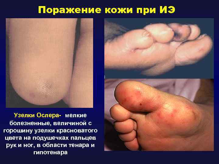 Поражение кожи при ИЭ Узелки Ослера- мелкие болезненные, величиной с горошину узелки красноватого цвета
