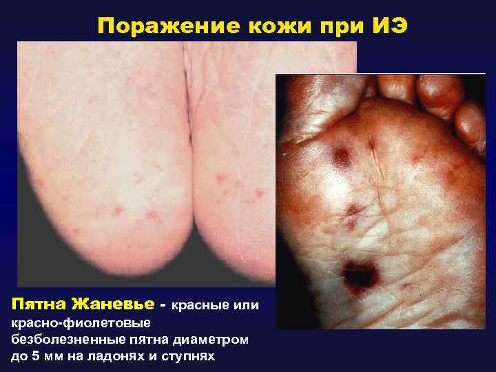 Поражение кожи при ИЭ Пятна Жаневье - красные или красно-фиолетовые безболезненные пятна диаметром до