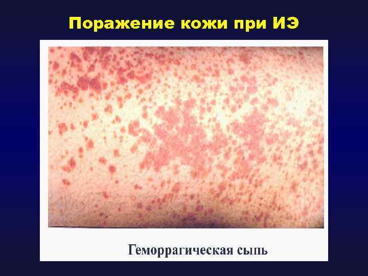 Поражение кожи при ИЭ 