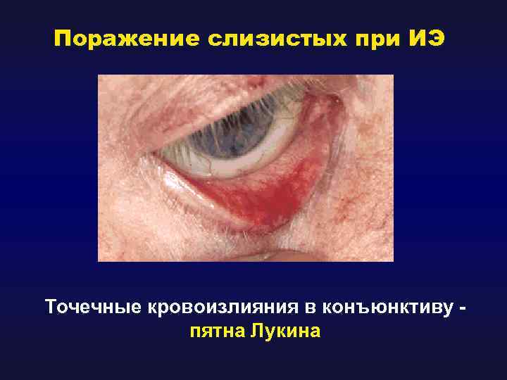 Поражение слизистых при ИЭ Точечные кровоизлияния в конъюнктиву пятна Лукина 