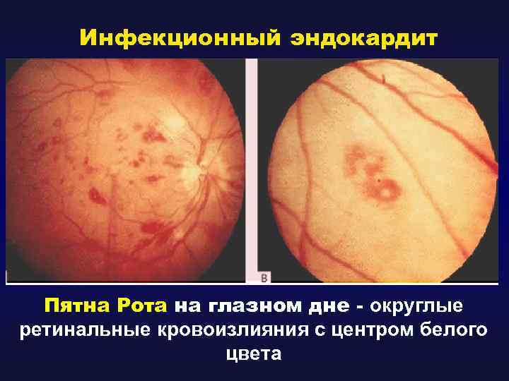 Инфекционный эндокардит Пятна Рота на глазном дне - округлые ретинальные кровоизлияния с центром белого