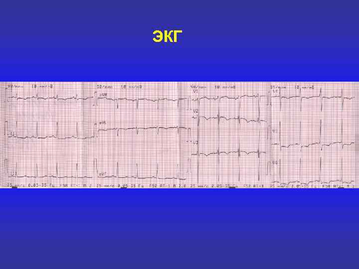 ЭКГ 