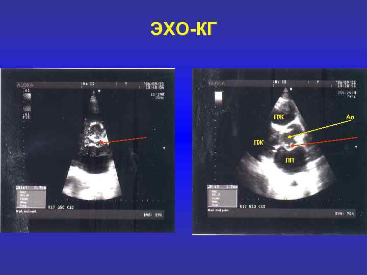 ЭХО-КГ ПЖ Ао ЛЖ ЛП 