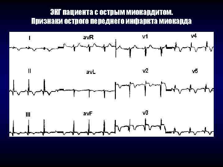  ЭКГ пациента с острым миокардитом. Признаки острого переднего инфаркта миокарда 