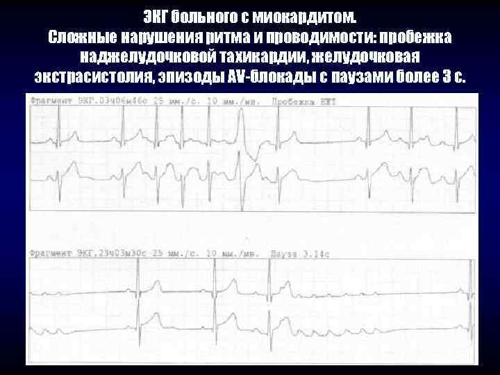    ЭКГ больного с миокардитом.  Сложные нарушения ритма и проводимости: пробежка