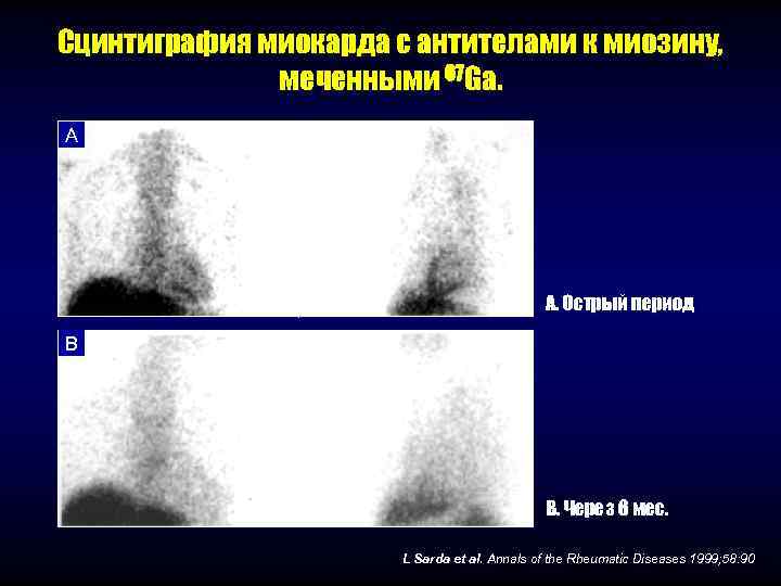 Сцинтиграфия миокарда с антителами к миозину,    меченными 67 Ga. A 