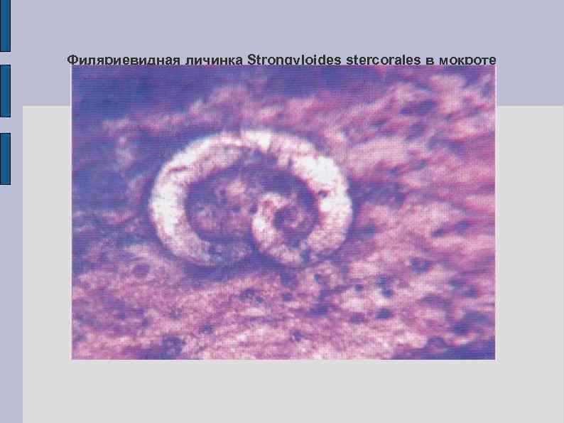 Филяриевидная личинка Strongyloides stercorales в мокроте 