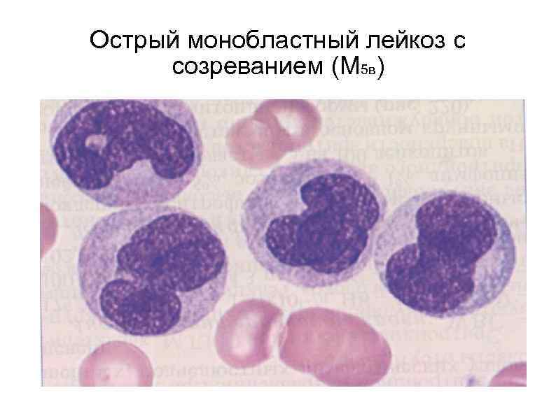 Острый монобластный лейкоз с созреванием (М 5 в) 