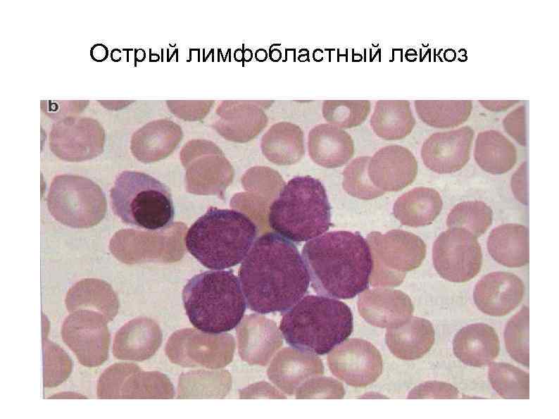 Острый лимфобластный лейкоз 