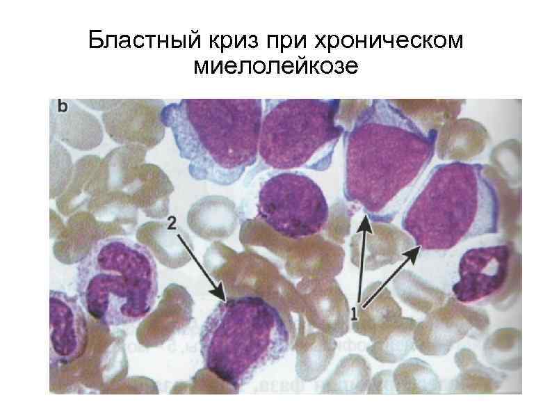 Бластный криз при хроническом  миелолейкозе 