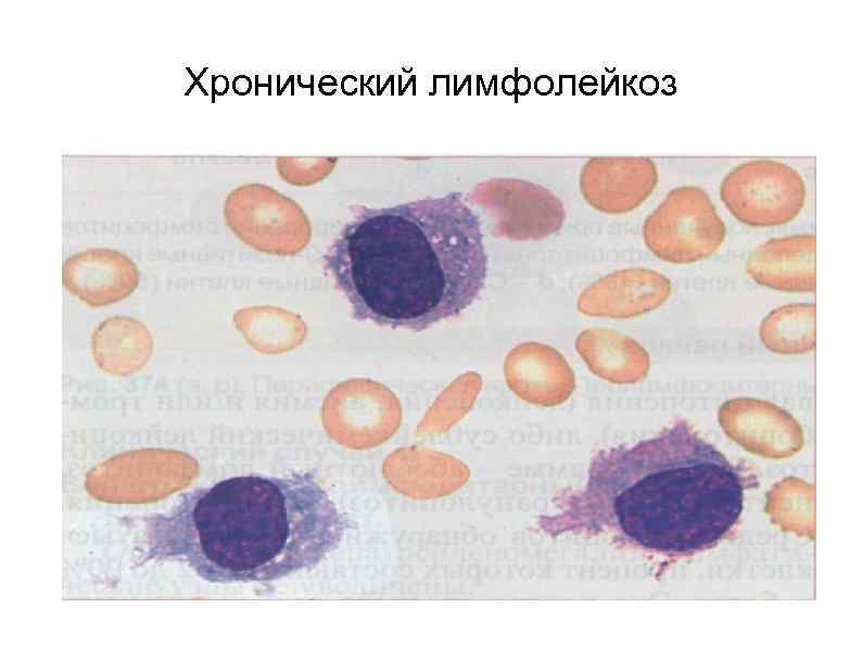 Хронический лимфолейкоз 
