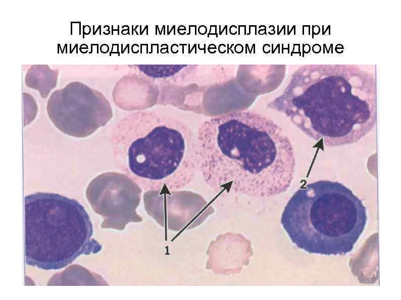  Признаки миелодисплазии при миелодиспластическом синдроме 