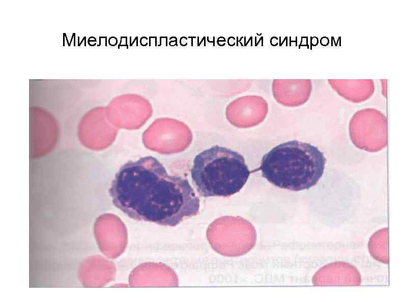 Миелодиспластический синдром 