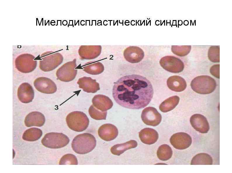 Миелодиспластический синдром 