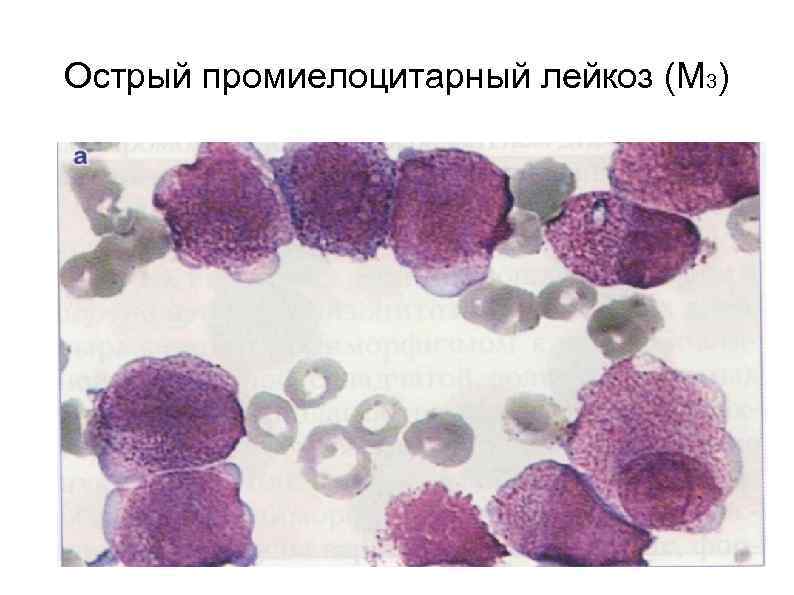 Острый промиелоцитарный лейкоз (М 3) 