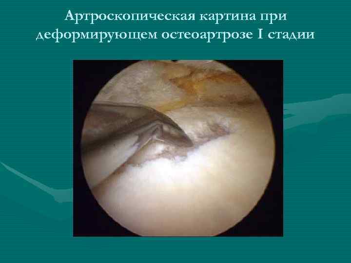  Артроскопическая картина при деформирующем остеоартрозе I стадии 