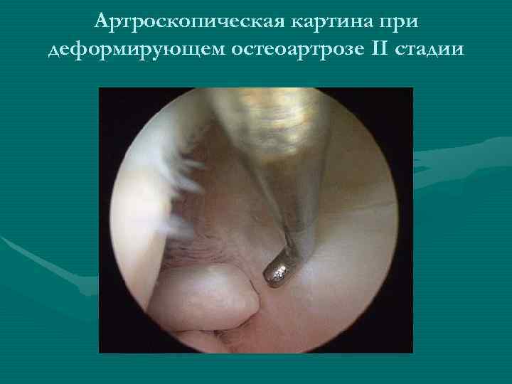   Артроскопическая картина при деформирующем остеоартрозе II стадии 