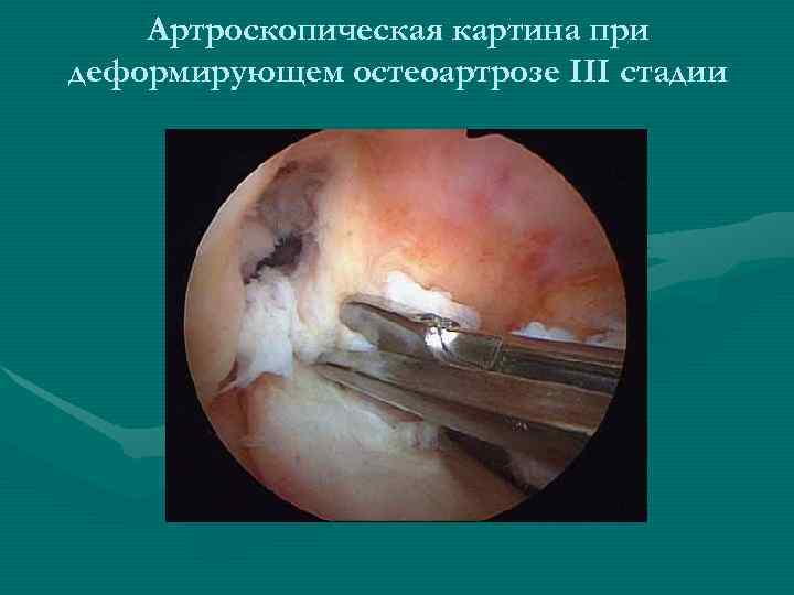   Артроскопическая картина при деформирующем остеоартрозе III стадии 