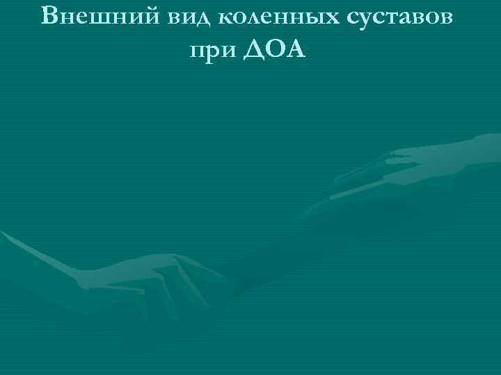 Внешний вид коленных суставов  при ДОА 