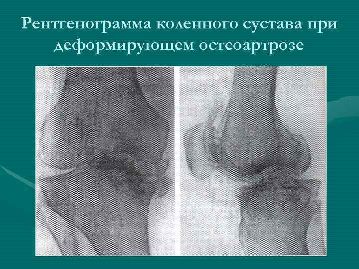 Рентгенограмма коленного сустава при  деформирующем остеоартрозе 