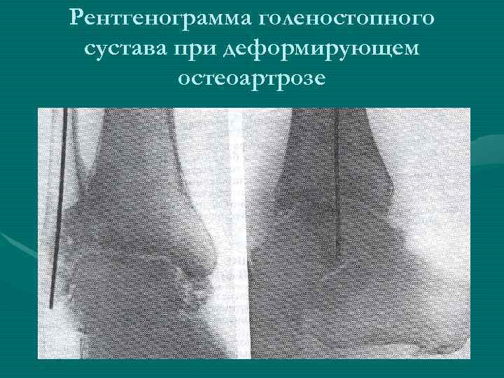 Рентгенограмма голеностопного сустава при деформирующем   остеоартрозе 