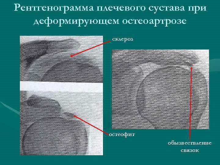 Рентгенограмма плечевого сустава при  деформирующем остеоартрозе    склероз   