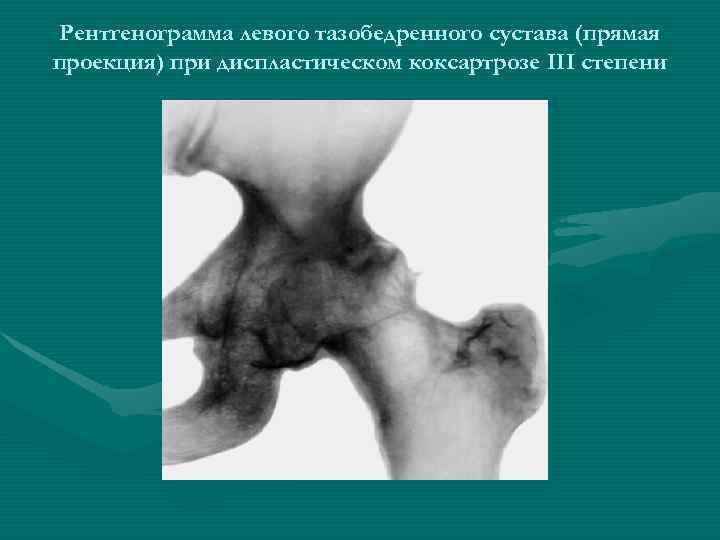 Рентгенограмма левого тазобедренного сустава (прямая проекция) при диспластическом коксартрозе III степени 