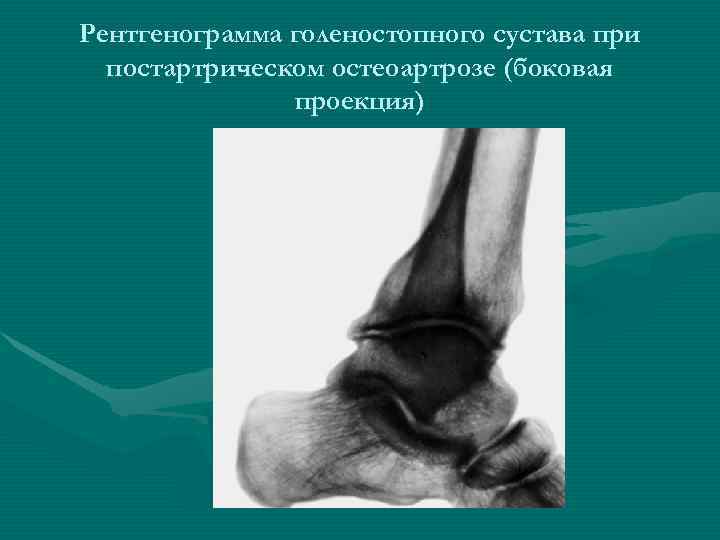 Рентгенограмма голеностопного сустава при  постартрическом остеоартрозе (боковая    проекция) 