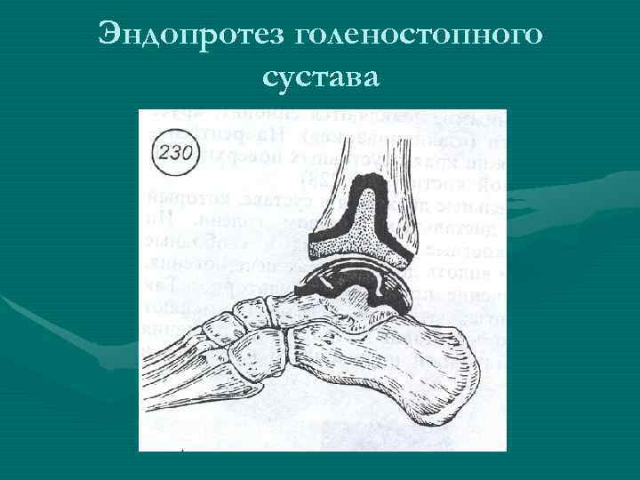 Эндопротез голеностопного   сустава 