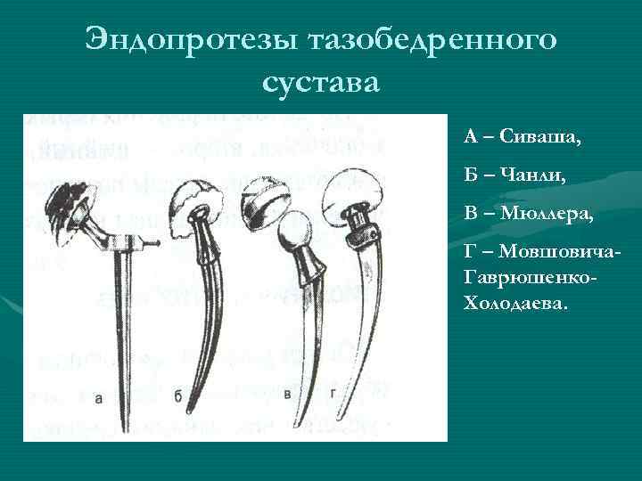 Эндопротезы тазобедренного   сустава     А – Сиваша,  