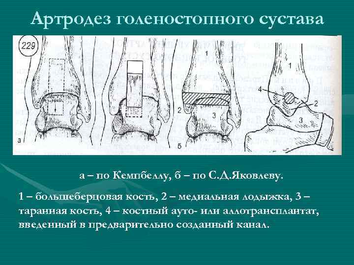  Артродез голеностопного сустава    а – по Кемпбеллу, б – по