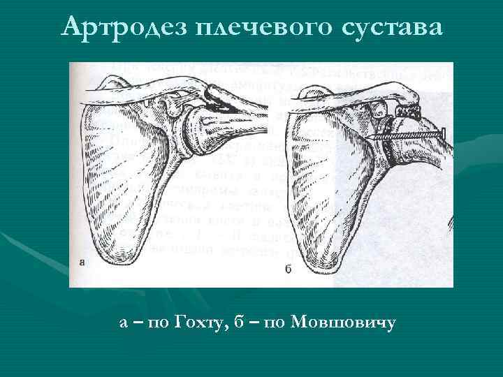 Артродез плечевого сустава  а – по Гохту, б – по Мовшовичу 