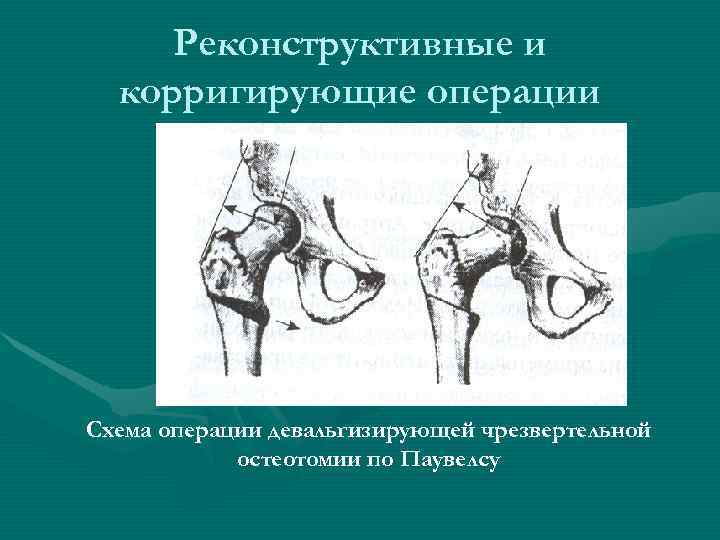  Реконструктивные и  корригирующие операции Схема операции девальгизирующей чрезвертельной   остеотомии по