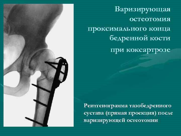   Варизирующая  остеотомия проксимального конца  бедренной кости  при коксартрозе Рентгенограмма
