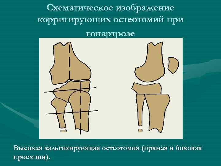   Схематическое изображение  корригирующих остеотомий при    гонартрозе Высокая вальгизирующая
