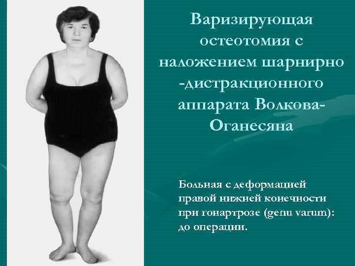   Варизирующая остеотомия с наложением шарнирно  -дистракционного  аппарата Волкова-  Оганесяна