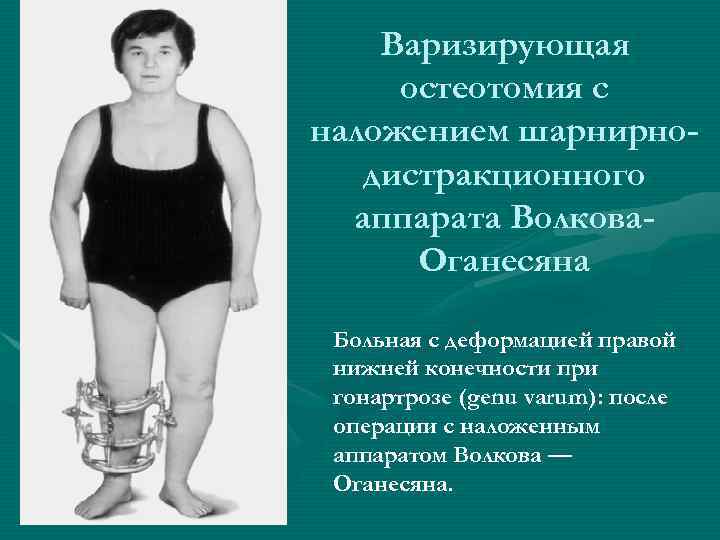   Варизирующая остеотомия с наложением шарнирно-  дистракционного  аппарата Волкова-  Оганесяна