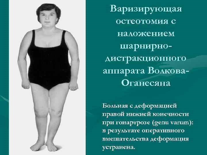  Варизирующая  остеотомия с  наложением шарнирно- дистракционного аппарата Волкова- Оганесяна Больная с