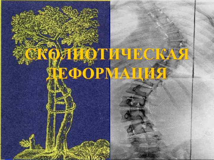 СКОЛИОТИЧЕСКАЯ ДЕФОРМАЦИЯ 
