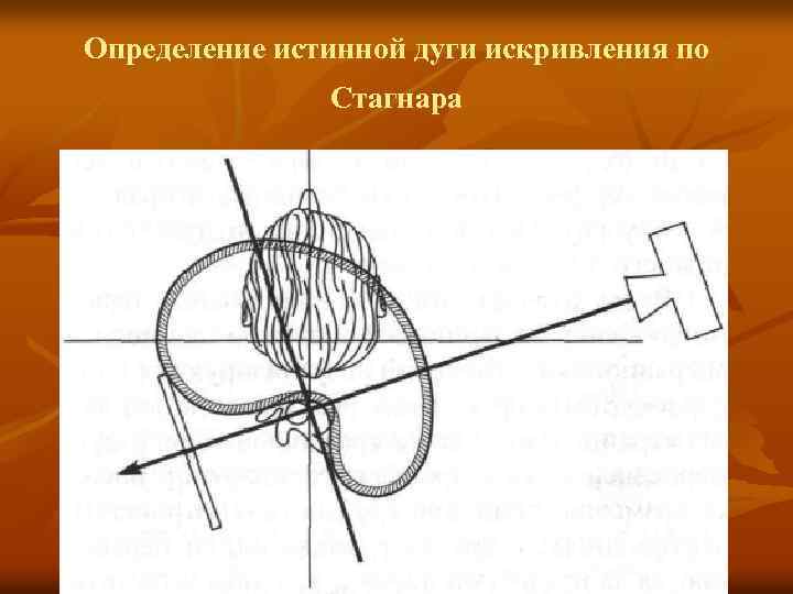Определение истинной дуги искривления по Стагнара 