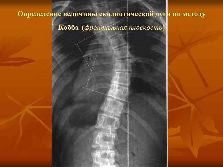 Определение величины сколиотической дуги по методу Кобба (фронтальная плоскость) 