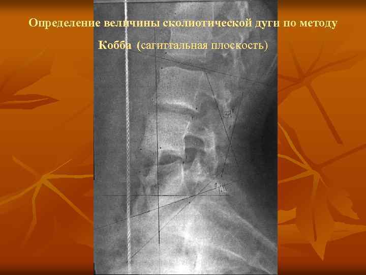 Определение величины сколиотической дуги по методу Кобба (сагиттальная плоскость) 