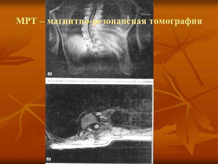 МРТ – магнитно-резонансная томография 
