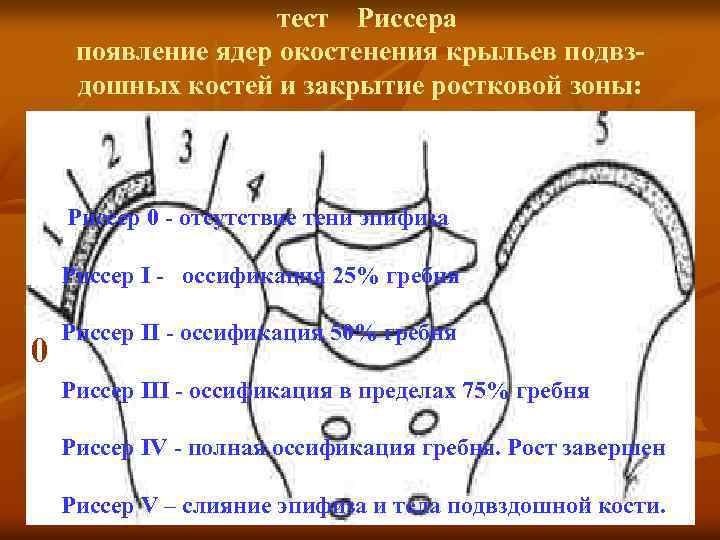 тест Риссера появление ядер окостенения крыльев подвздошных костей и закрытие ростковой зоны: Риссер 0