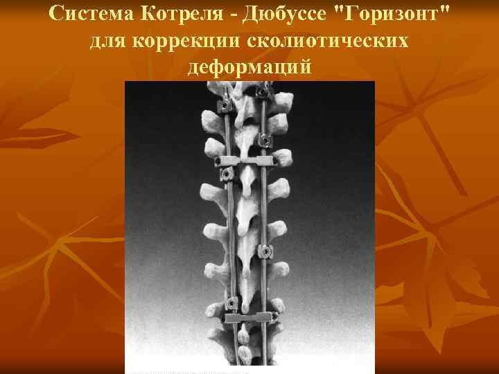 Система Котреля - Дюбуссе 