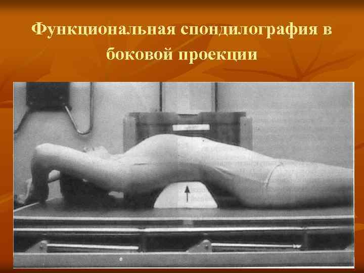 Функциональная спондилография в боковой проекции 