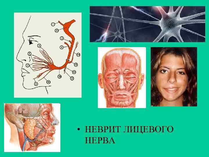  • НЕВРИТ ЛИЦЕВОГО НЕРВА 