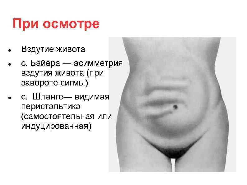 При осмотре Вздутие живота с. Байера — асимметрия вздутия живота (при завороте сигмы) с.